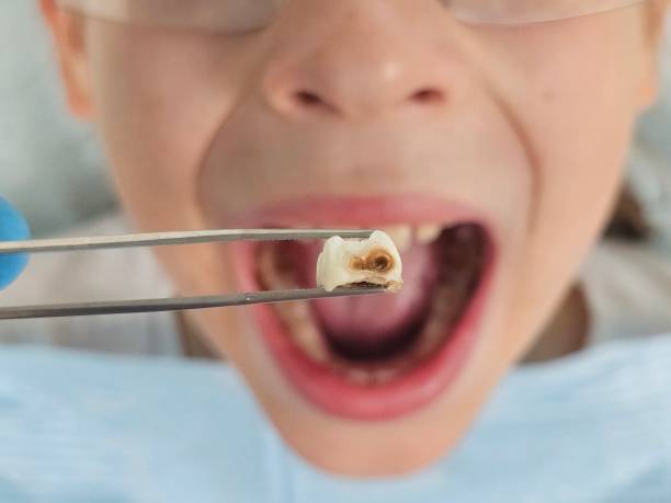 Best Emergency Wisdom Teeth Removal in Elmwood, LA